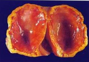 黄体功能不全是什么